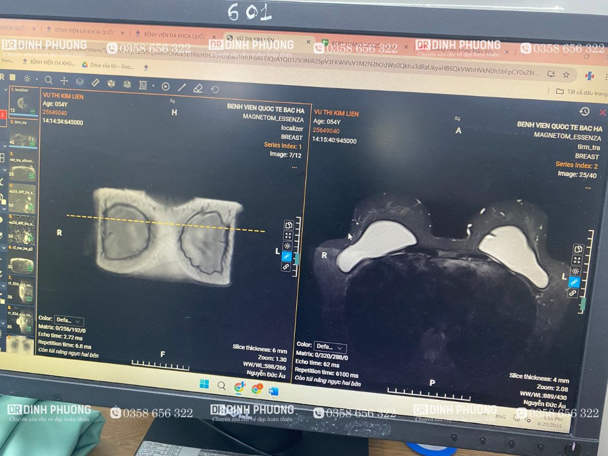 Bác sĩ Trần Phượng trực tiếp thăm khám đánh giá tình trạng túi ngực 