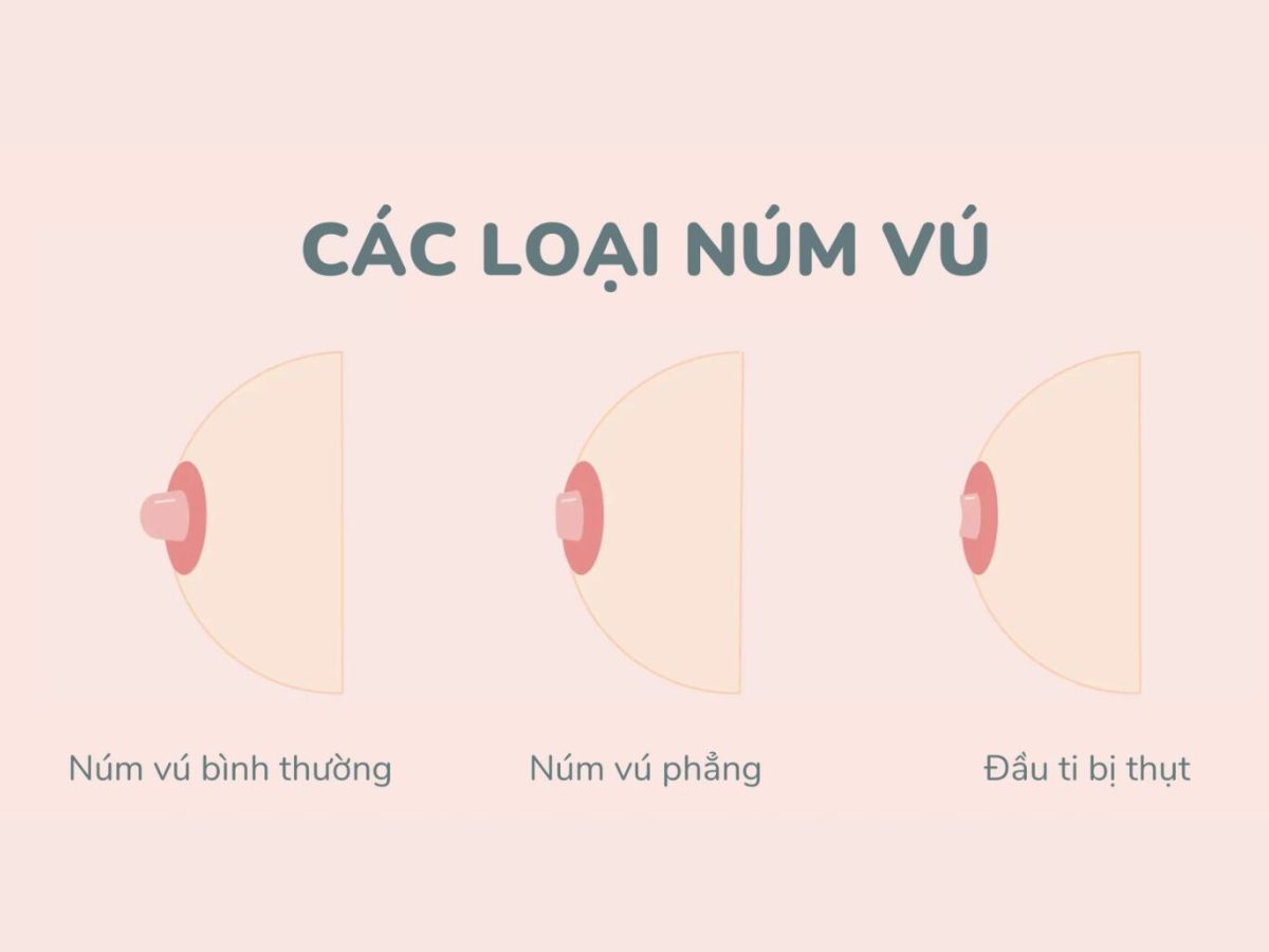 Phân biệt một số hình dạng nhũ hoa thường gặp