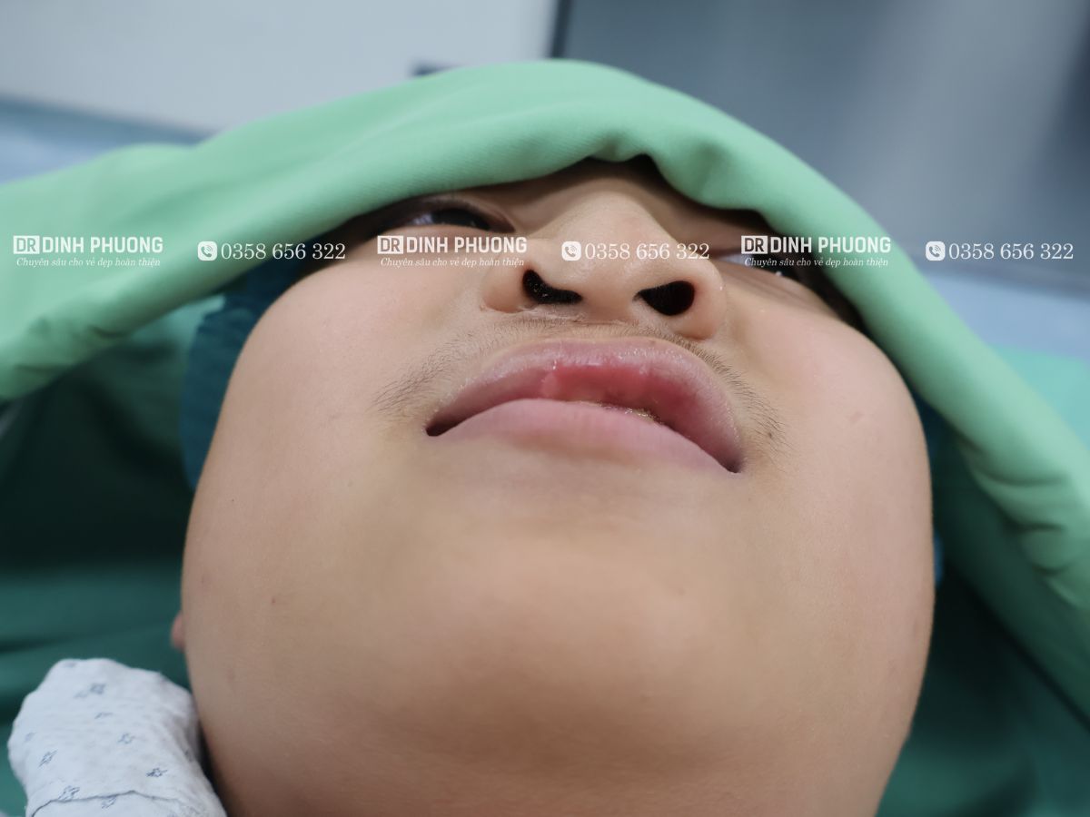 Thời điểm lý tưởng để thực hiện phẫu thuật thiểu sản xương hàm trên 