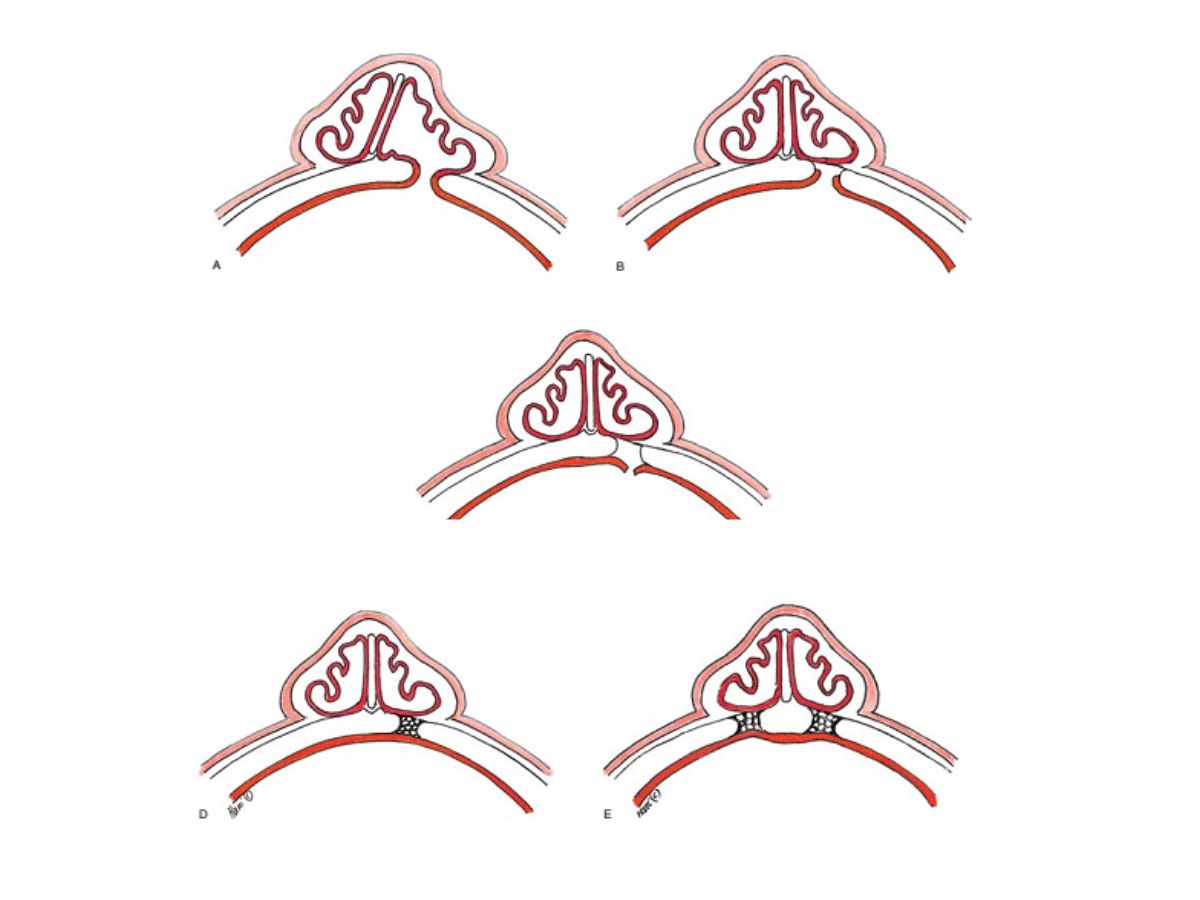 Điều trị khe hở xương hàm trên bằng phương pháp ghép xương tự thân