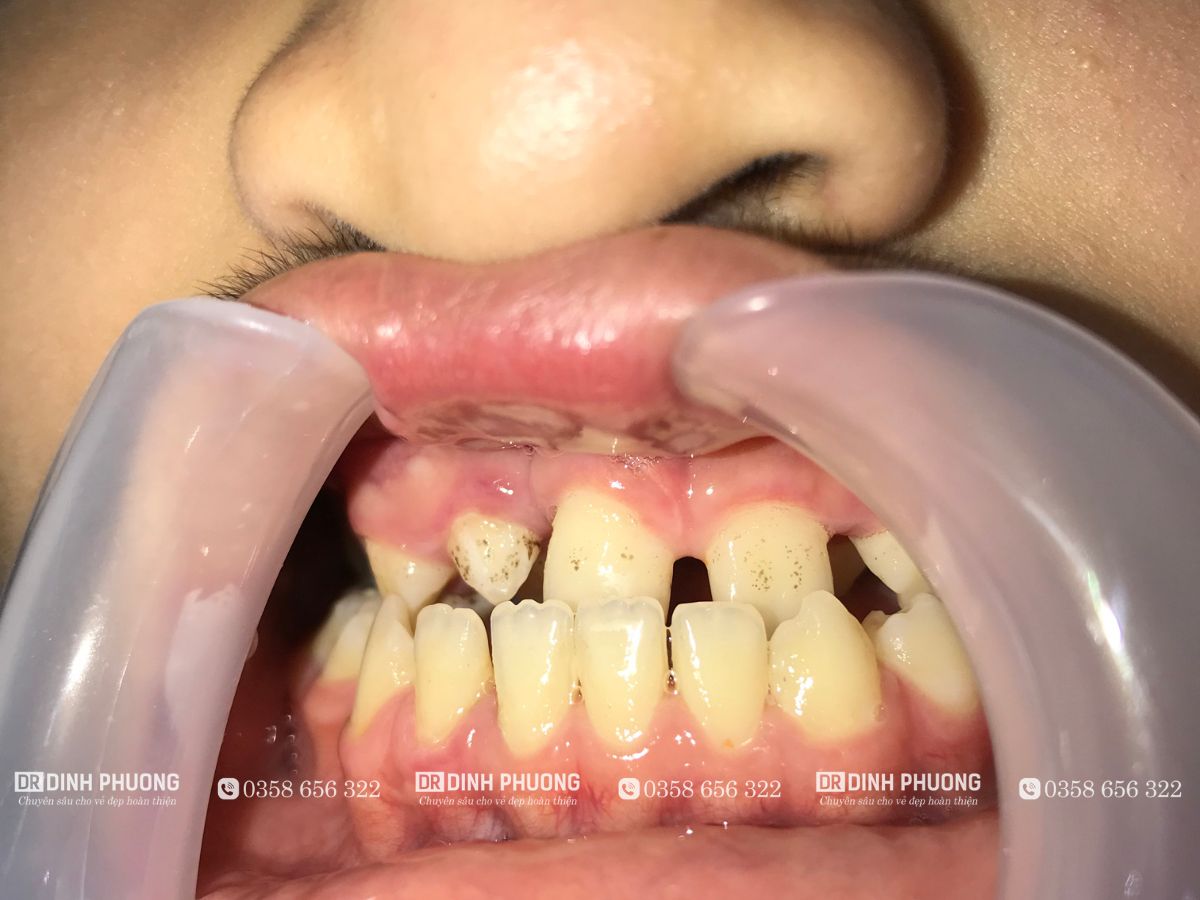 Đánh giá tình trạng khớp cắn là yếu tố cần thiết trước khi phẫu thuật thiểu sản xương hàm trên 