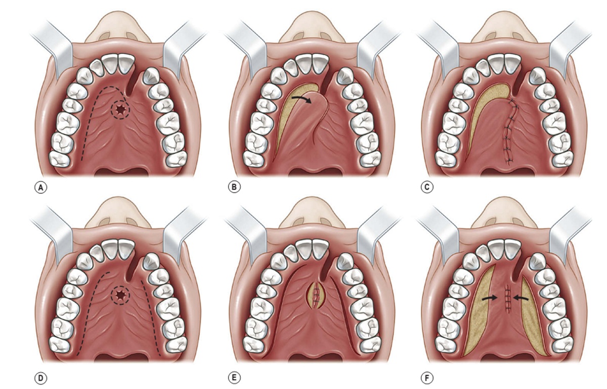 Kỹ thuật dùng vạt tại chỗ để điều trị di chứng thông mũi miệng 