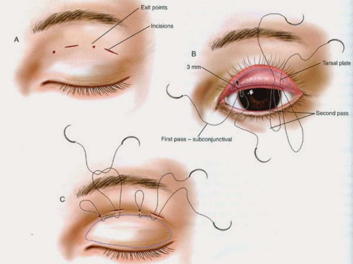Quy trình thực hiện nhấn mí an toàn, bền đẹp tự nhiên 
