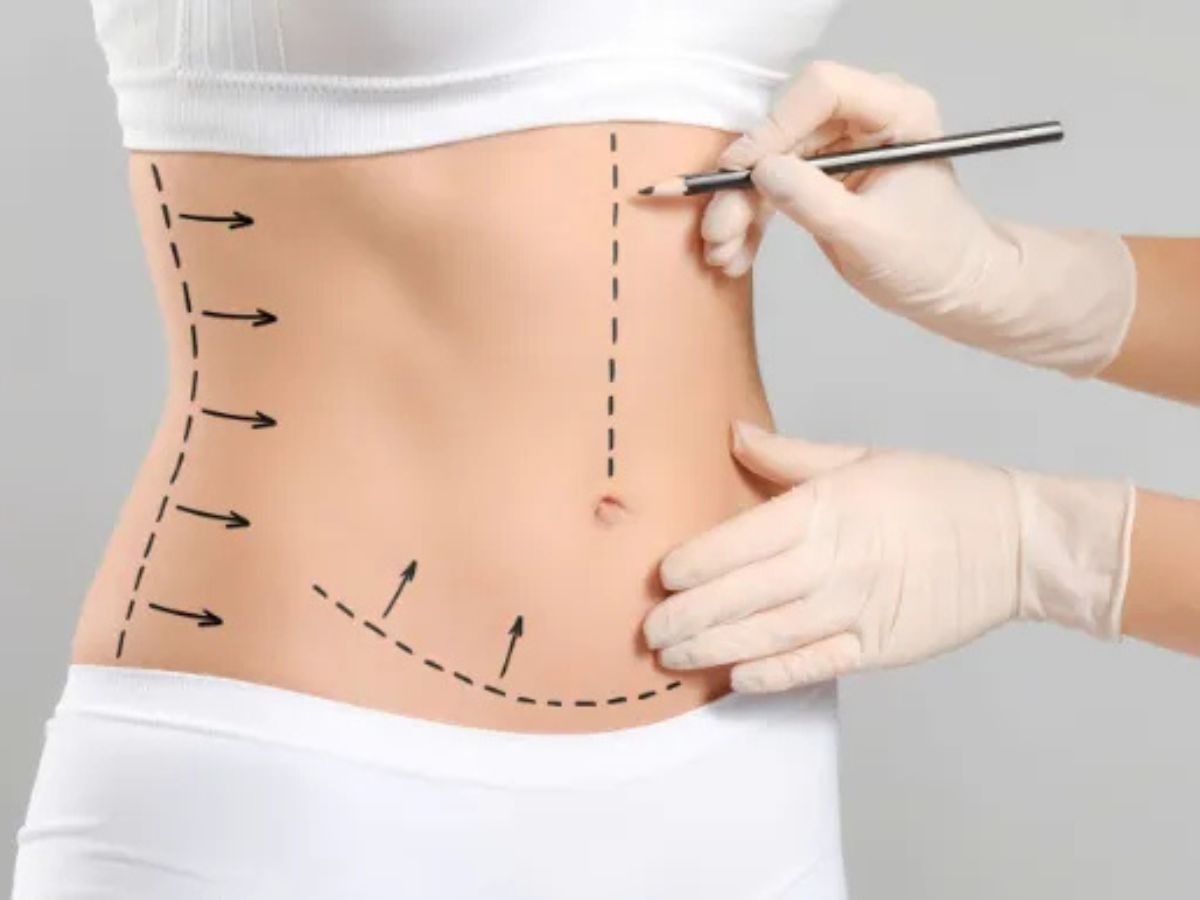 Bác sĩ thăm khám kỹ lượng và đo vẽ vùng mỡ cần loại bỏ 