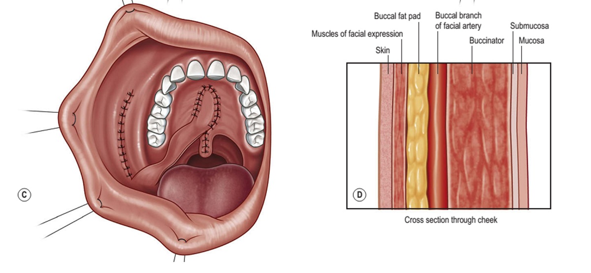 Sử dụng vạt cơ niêm mạc má điều trị di chứng thông mũi miệng có lỗ hổng lớn 