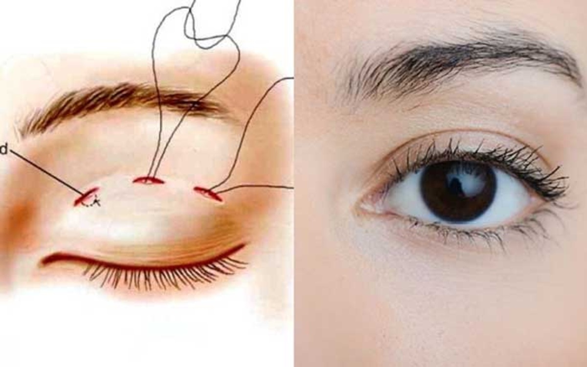 Nắm rõ những nguyên tắc “vàng” khi nhấn mí để mang lại kết quả tối ưu nhất