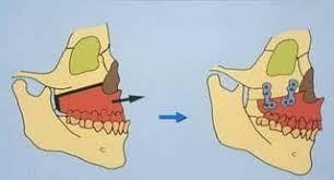 Kỹ thuật Le Fort I phẫu thuật thiểu sản xương hàm trên 