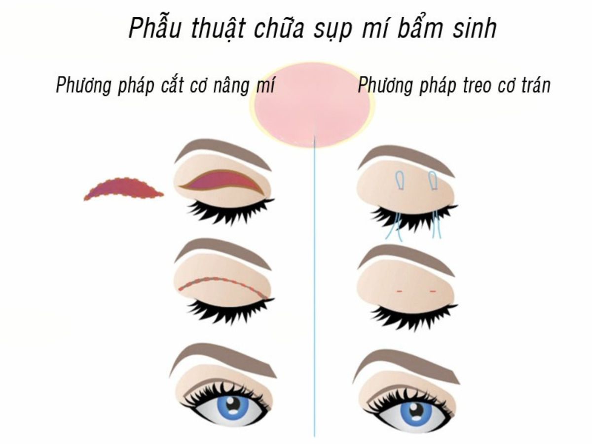 Các kỹ thuật điều trị sụp mí mắt bẩm sinh phổ biến hiện nay 