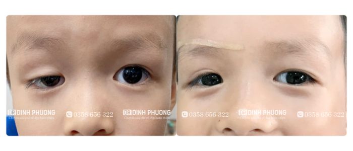Hình ảnh 1 ca điều trị sụp mí bẩm sinh của bác sĩ CK2 Trần Đình Phượng 