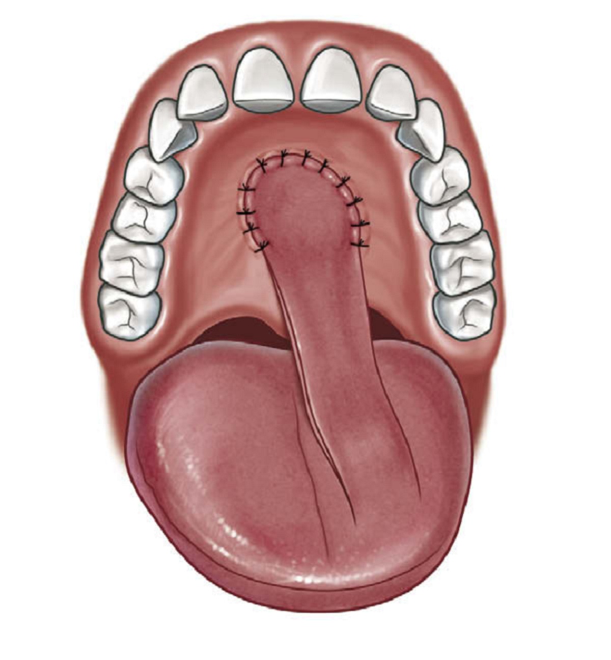 Với lỗ thông có kích thước lớn có thể sử dụng vạt lưỡi để thực hiện điều trị di chứng 