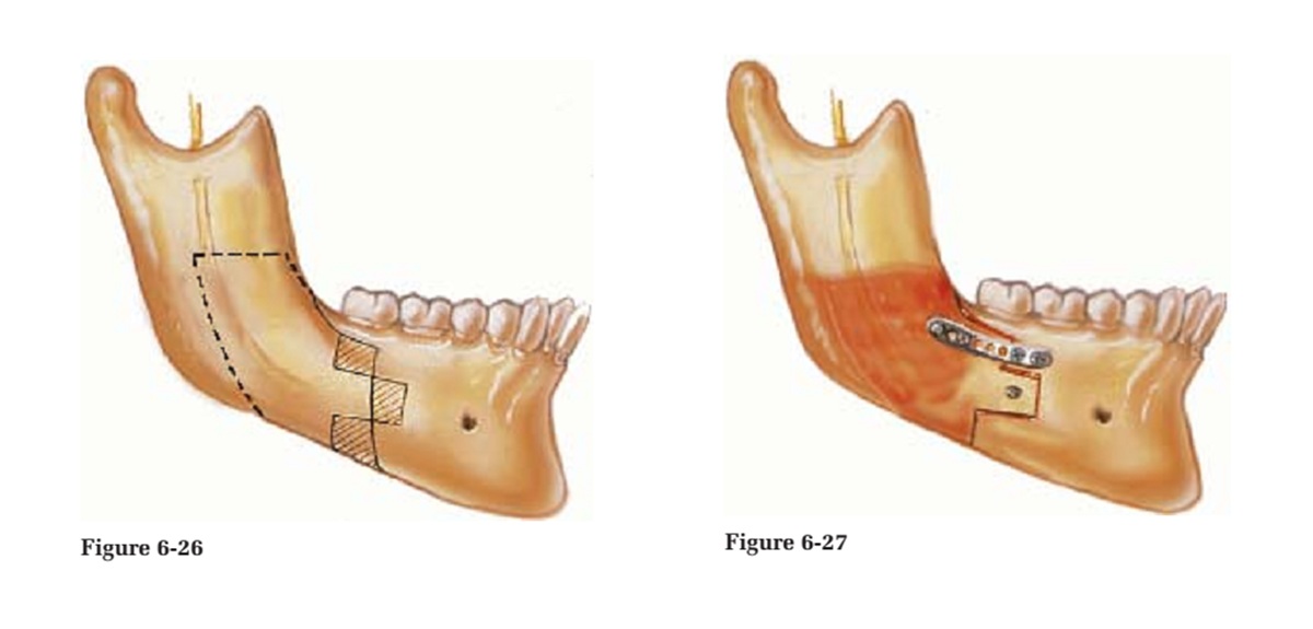 Kỹ thuật phối hợp di chuyển xương hàm dưới để phẫu thuật thiểu sản xương hàm trên