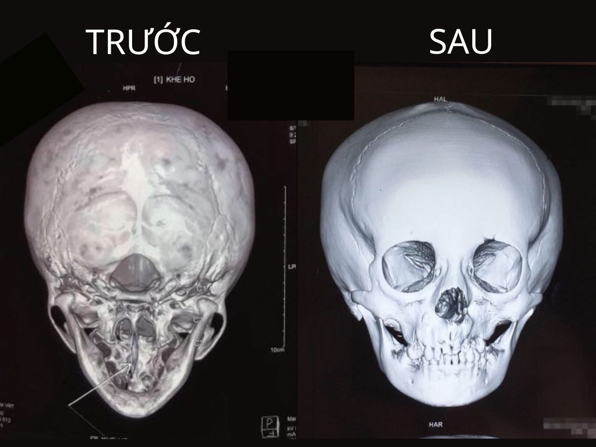 Hình ảnh trước và sau khi điều trị khe hở xương hàm trên