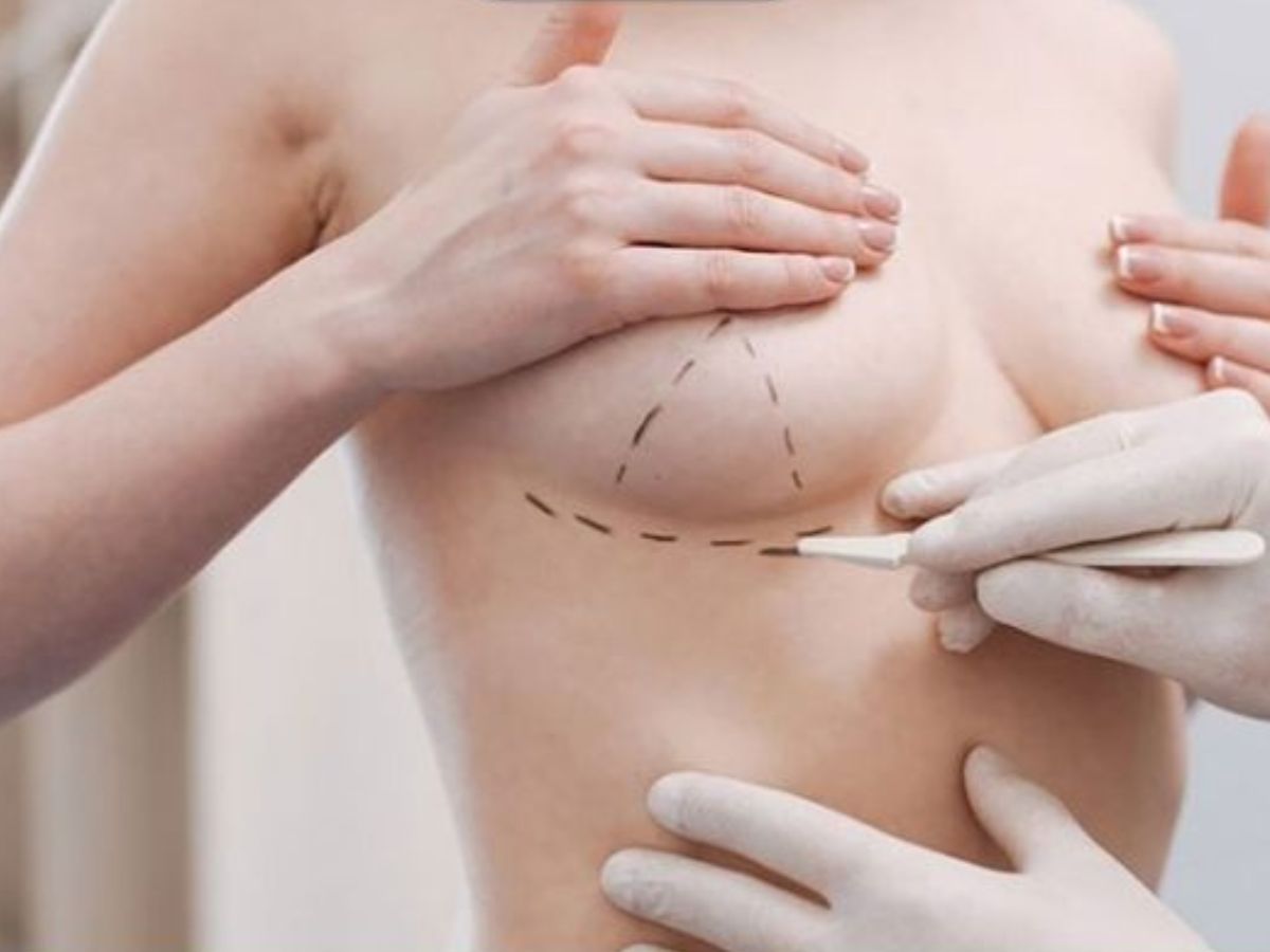 Tháo túi ngực hầu như không để lại sẹo nếu được thực hiện bởi bác sĩ tay nghề cao 