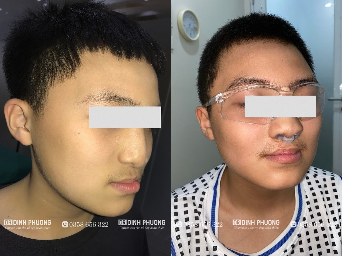 Hình ảnh trước và sau khi bác sĩ phẫu thuật thiểu sản xương hàm trên cho bệnh nhân