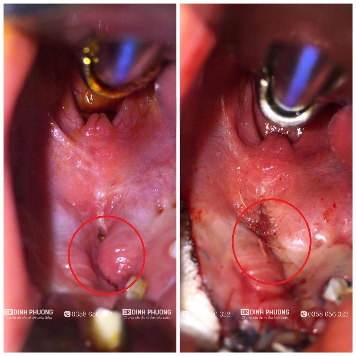 Hình Ảnh trước và sau khi phẫu thuật đóng kín lỗ thông của bệnh nhân