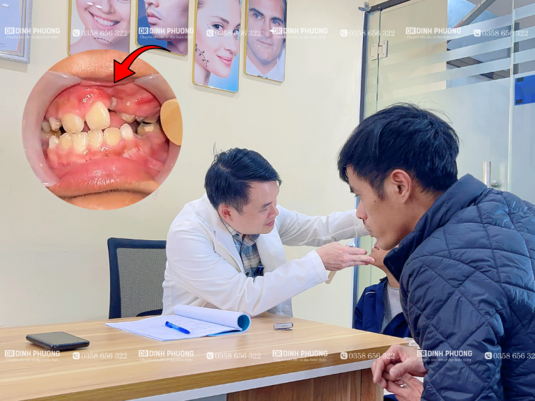 Khe hở xương hàm trên