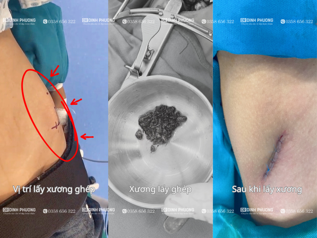 Ghép xương hàm trên