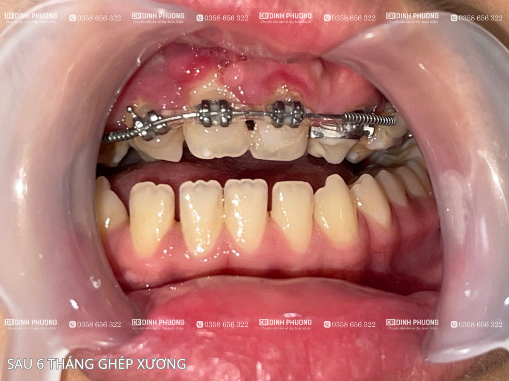 Kết quả sau ghép xương