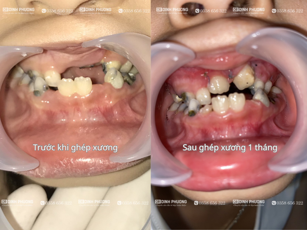 Hình ảnh sau ghép xương