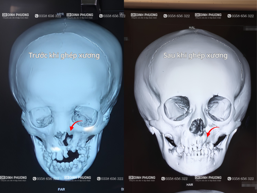 kết quả ghép xương hàm trên qua hình ảnh phim chụp