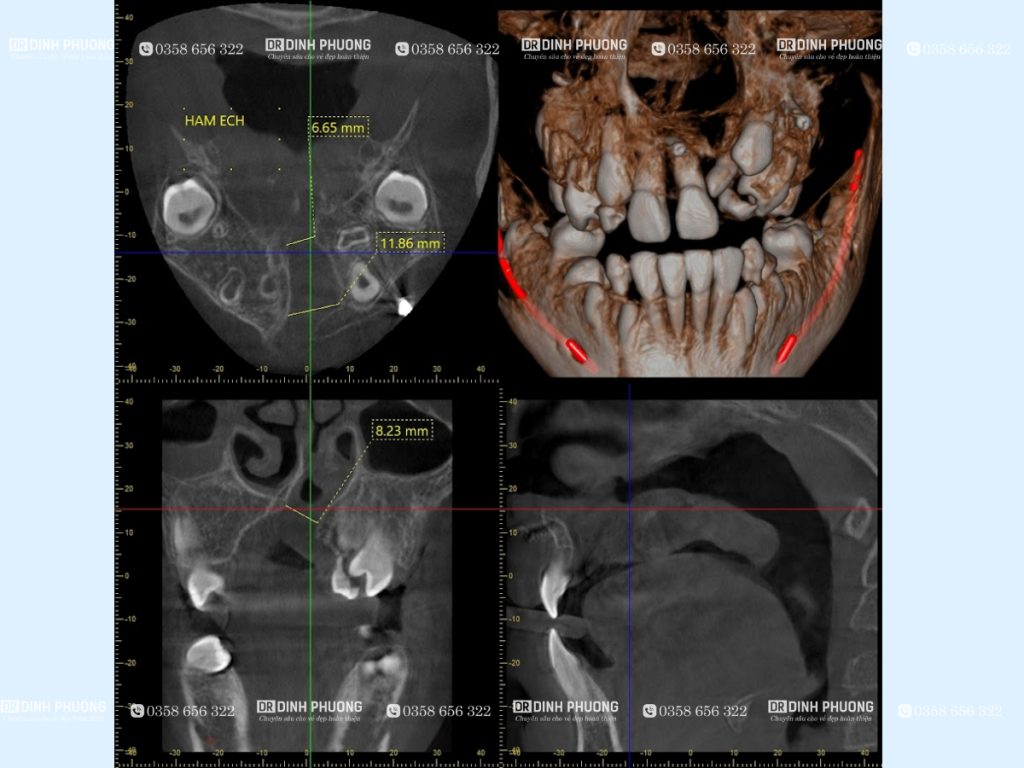 Phim chụp để đánh gía ghép xương