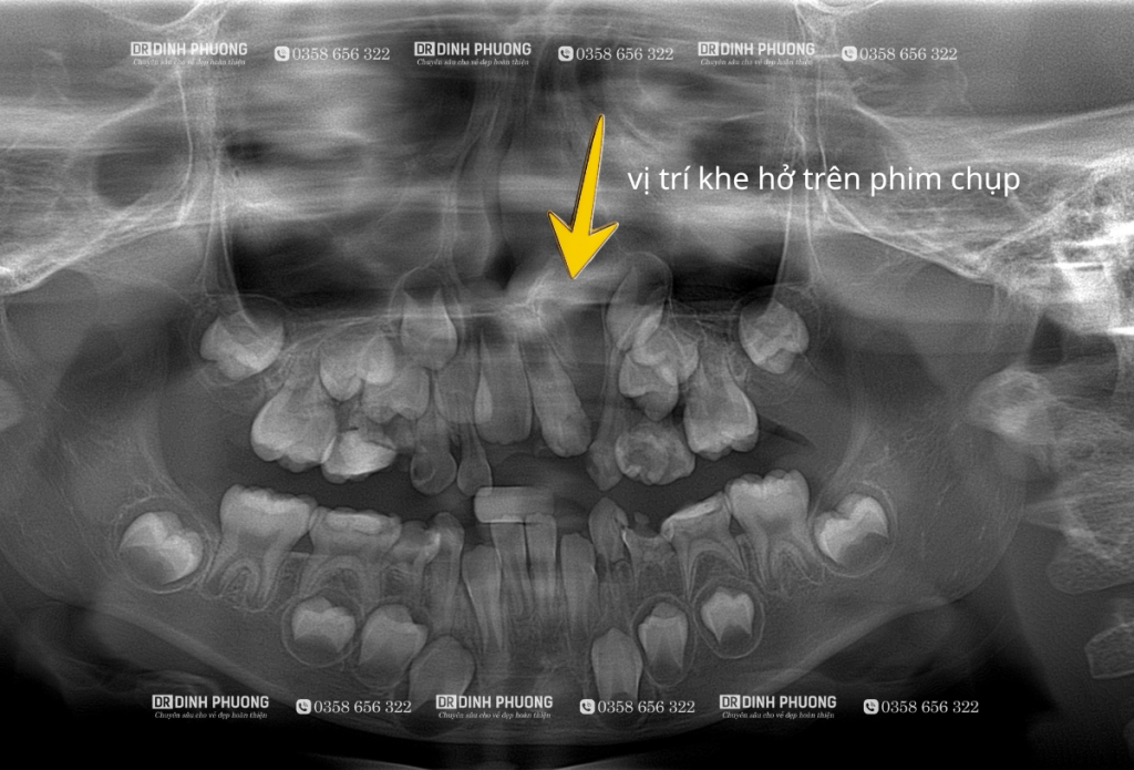 Ghép xương hàm trên điều trị khe hở xương hàm trên