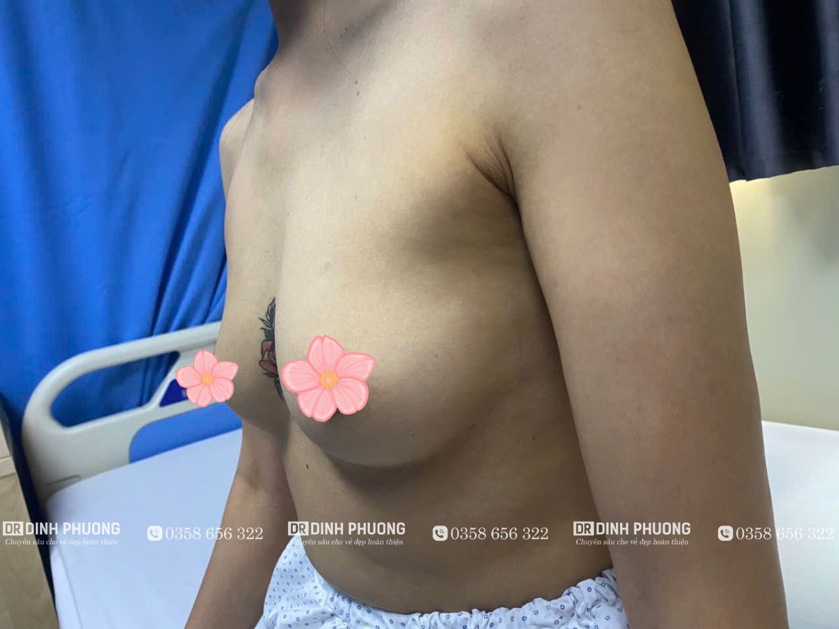 Đối tượng nào nên lựa chọn nâng ngực thẩm mỹ?