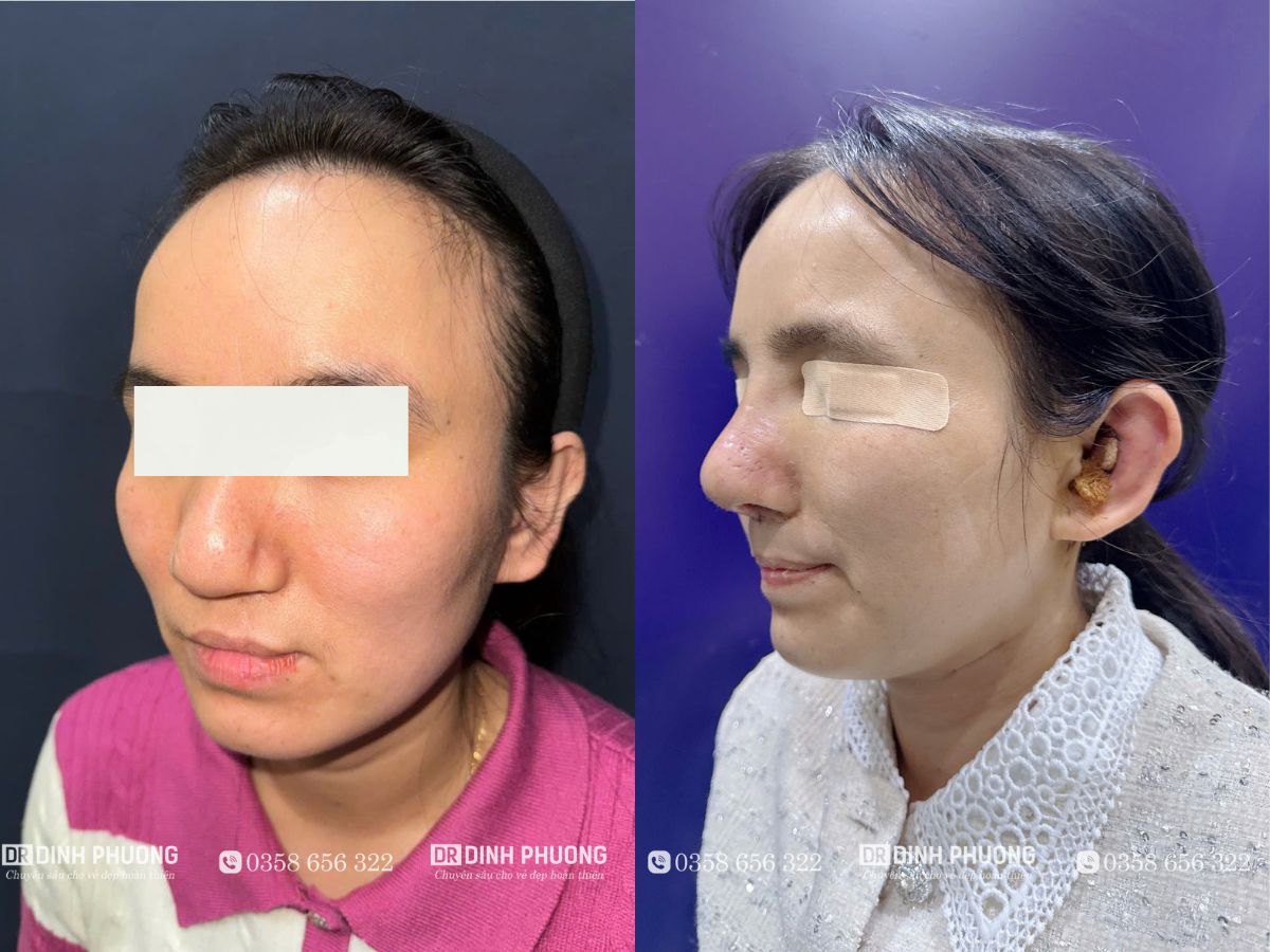 Hình ảnh mũi trước và sau khi bệnh nhân được bác sĩ Phượng phẫu thuật 