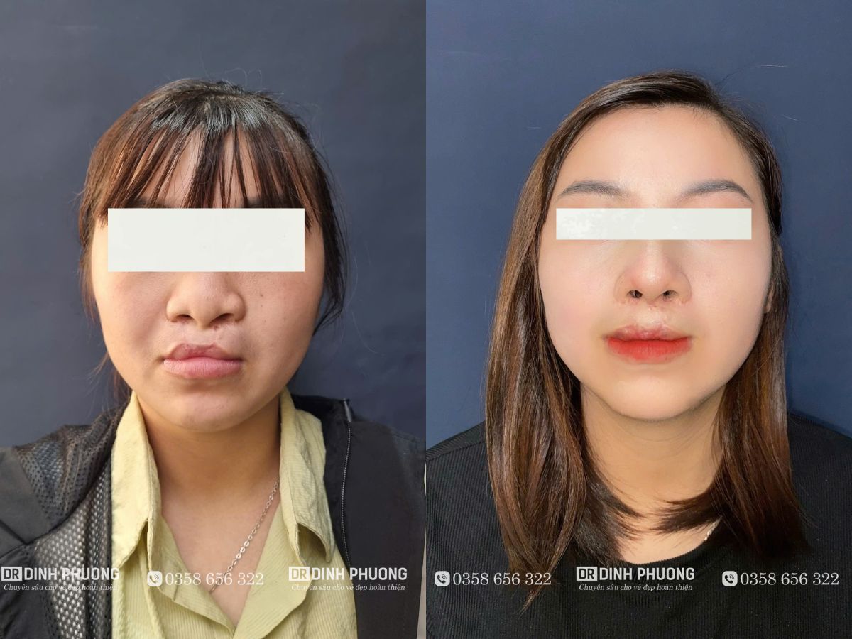 Hình ảnh mũi trước và sau khi bệnh nhân được bác sĩ Phượng phẫu thuật 