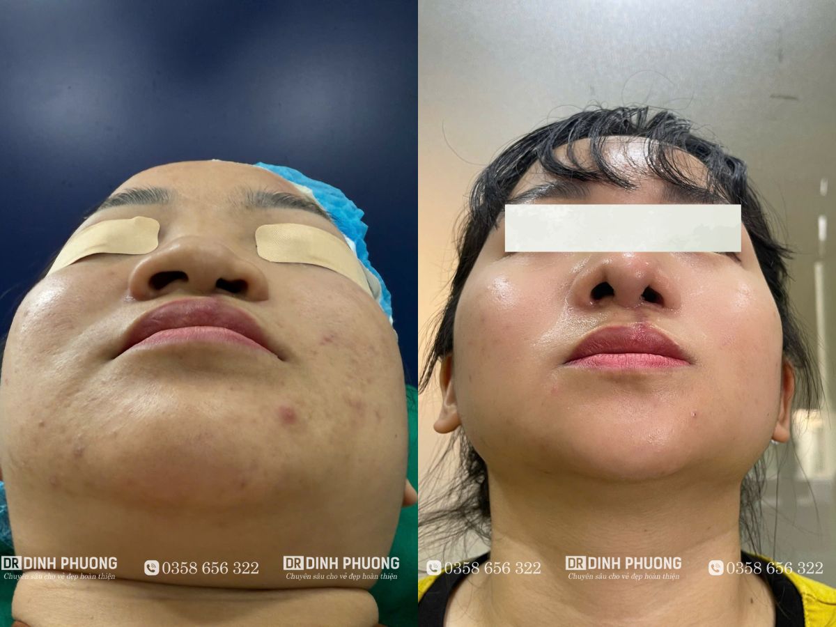 Hình ảnh trước và sau khi phẫu thuật mũi cho bệnh nhân bị khe hở môi