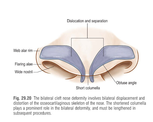 Tình trạng biến dạng mũi do khe hở môi hai bên