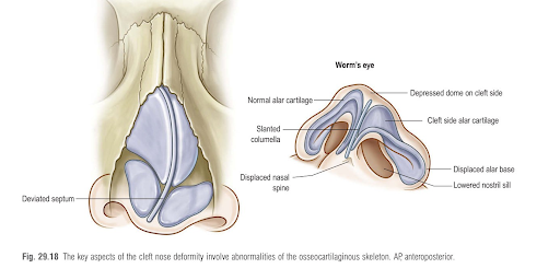 Tình trạng biến dạng cấu trúc mũi trong khe hở môi một bên