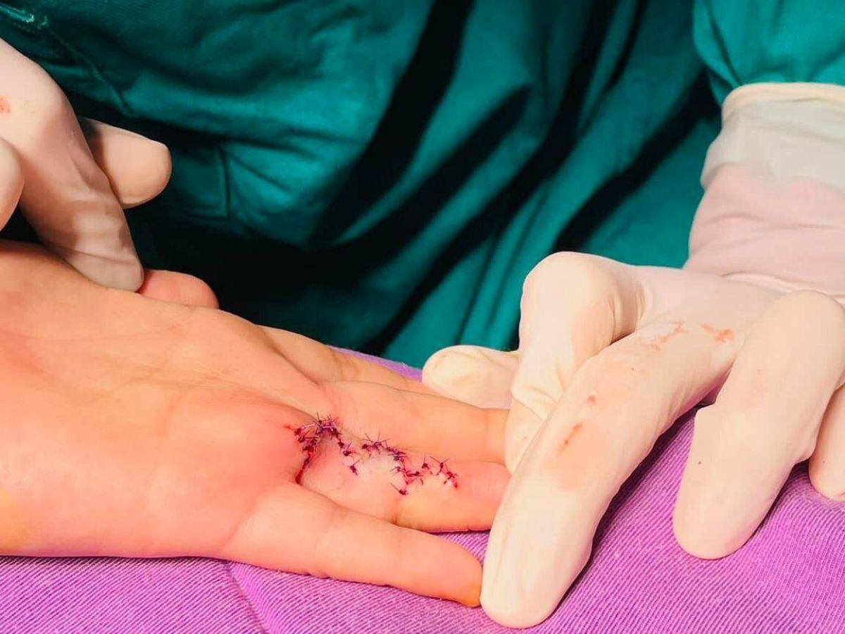 Các phương pháp điều trị sẹo co kéo ngón tay