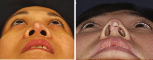 Da đầu mũi mỏng hoặc thủng da đầu mũi