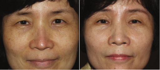 Da mũi bị mỏng, đỏ sau nâng mũi