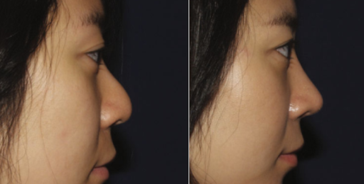 Đầu mũi bị biến dạng đầu tù