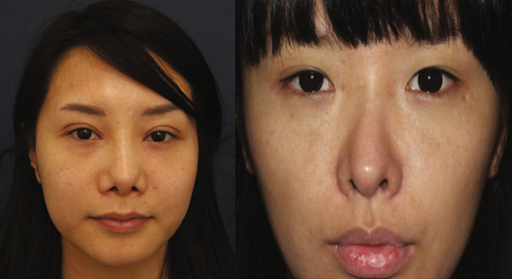 Đầu mũi biến dạng bị kẹp