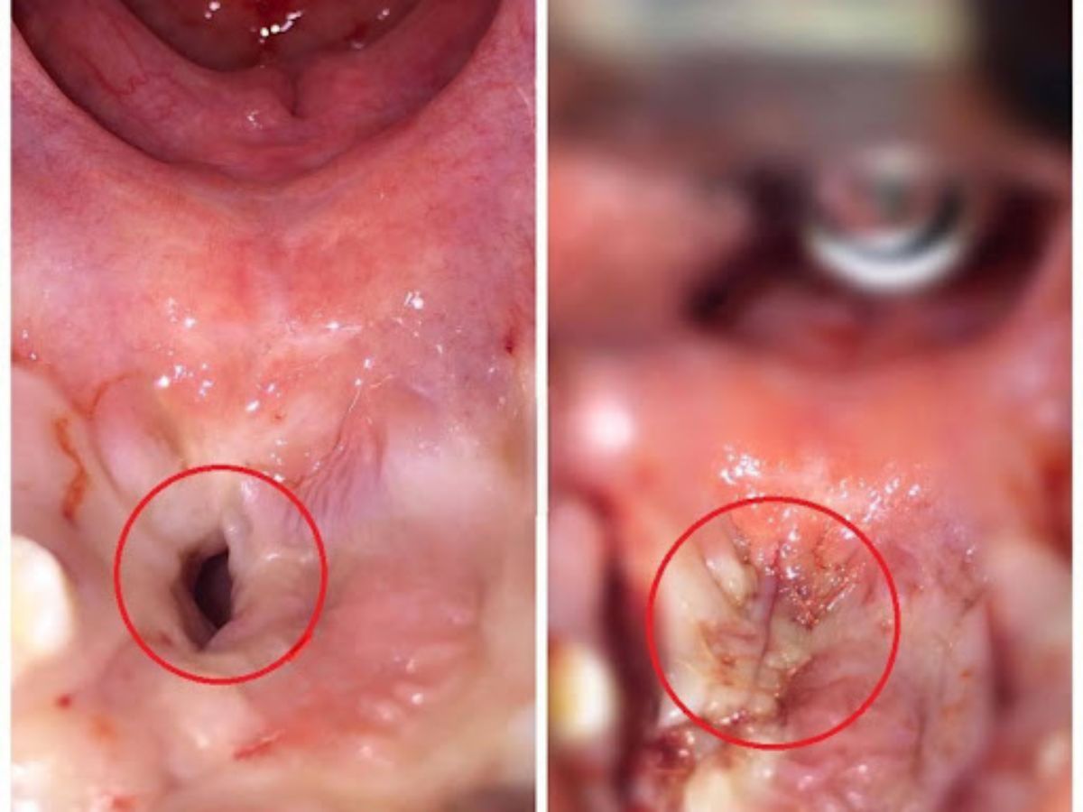 Tìm hiểu về phương pháp điều trị di chứng thông mũi miệng sau phẫu thuật khe hở môi - vòm