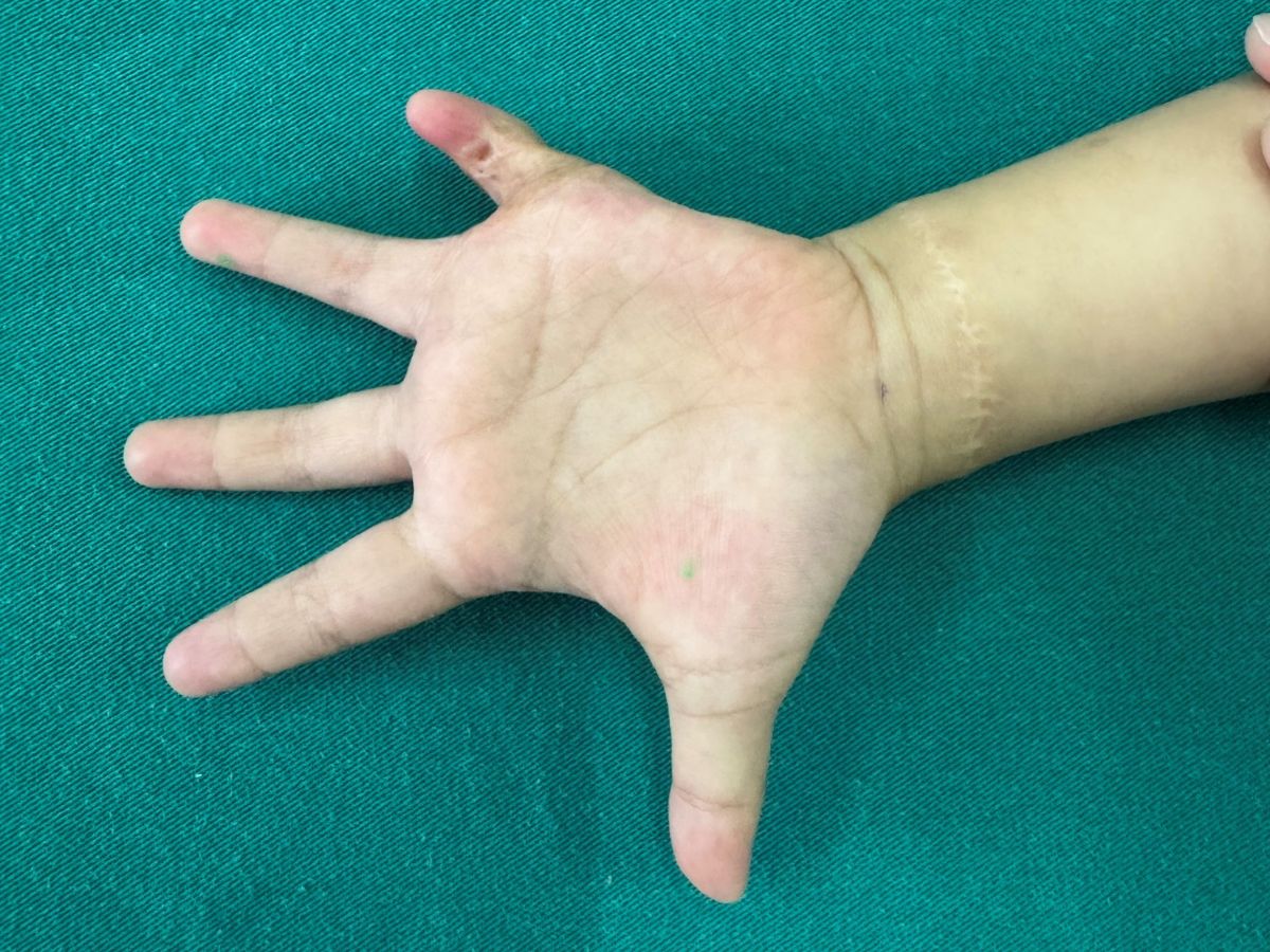 Sẹo co kéo ngón tay là gì?