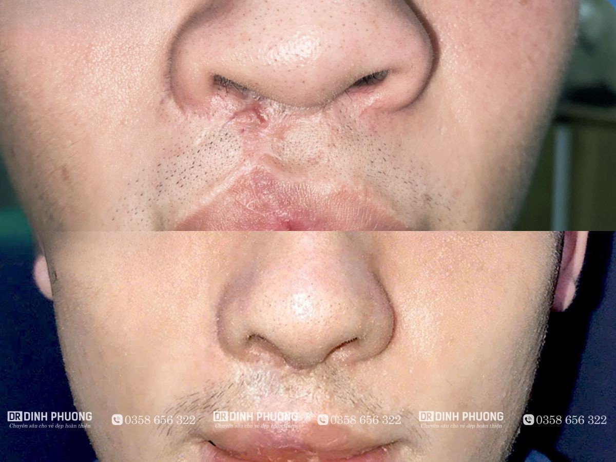 Hình ảnh mũi trước và sau khi bệnh nhân được bác sĩ Phượng phẫu thuật 