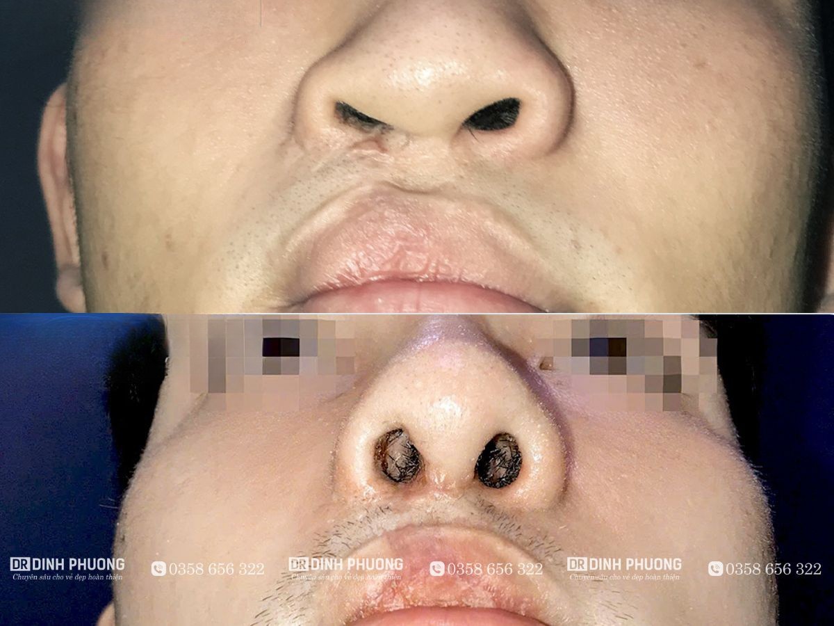 Hình ảnh mũi trước và sau khi bệnh nhân được bác sĩ Phượng phẫu thuật 