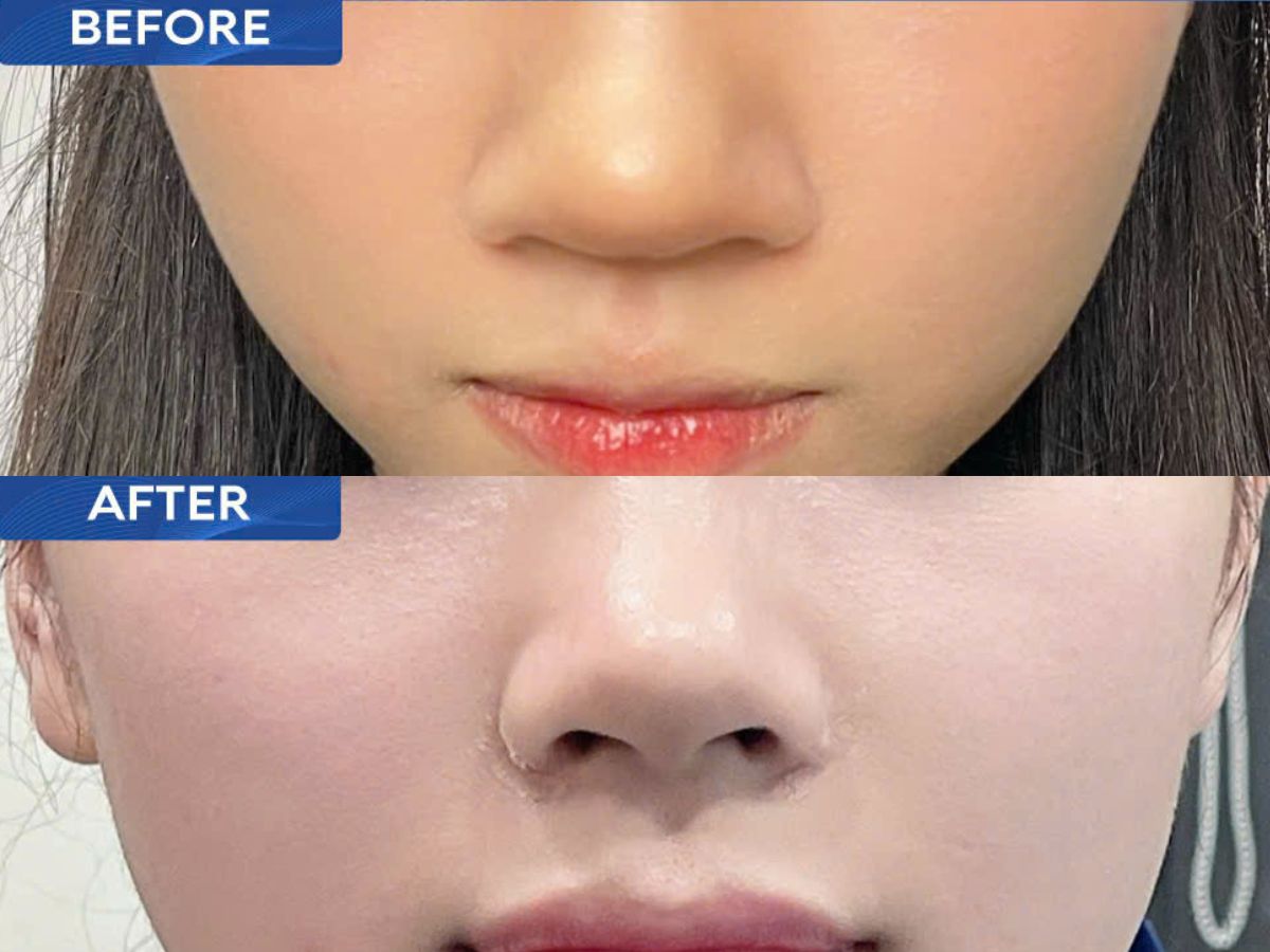 Hình ảnh trước và sau khi sửa mũi tại bác sĩ Trần Đình Phượng