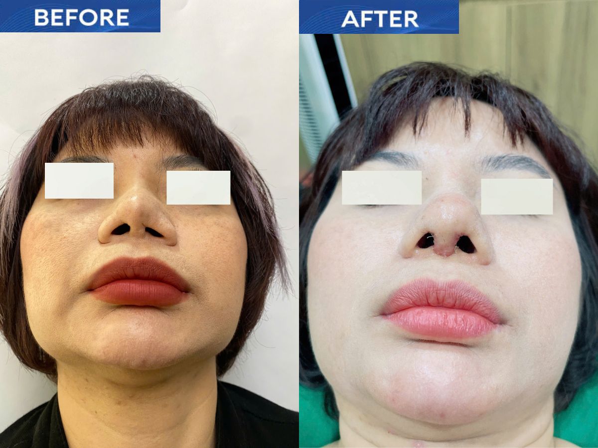 Hình ảnh trước và sau khi sửa mũi tại bác sĩ Trần Đình Phượng