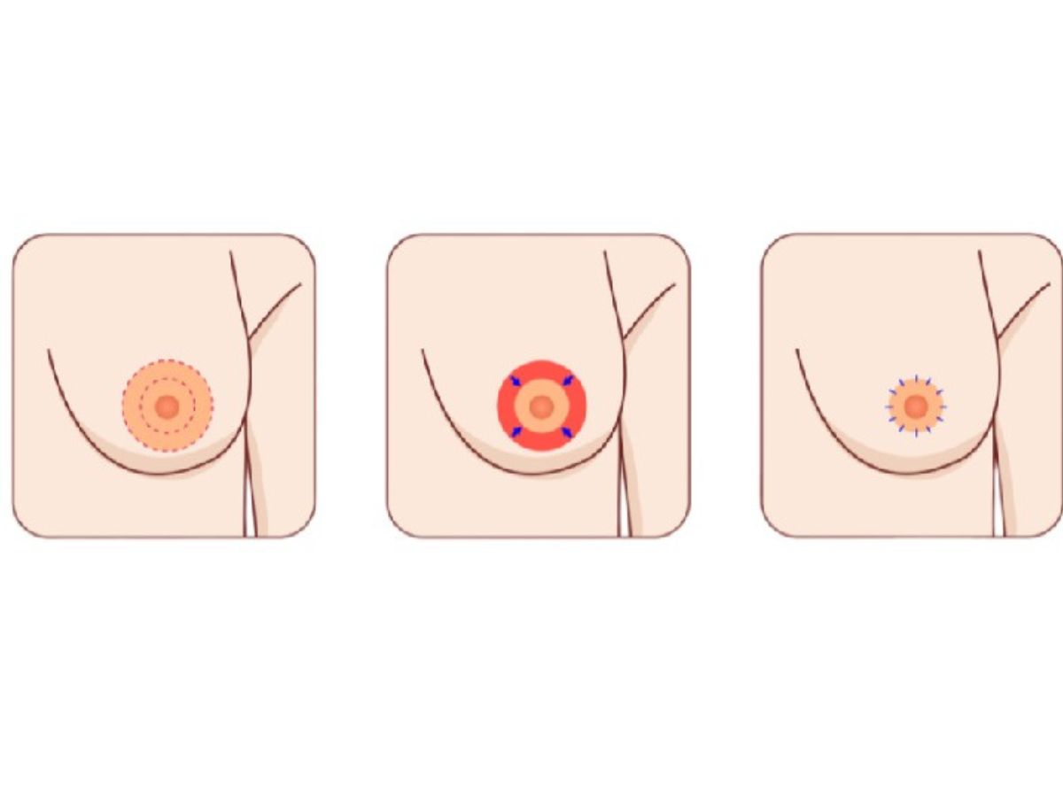 Khi nào nên cân nhắc thực hiện thu nhỏ quầng vú?