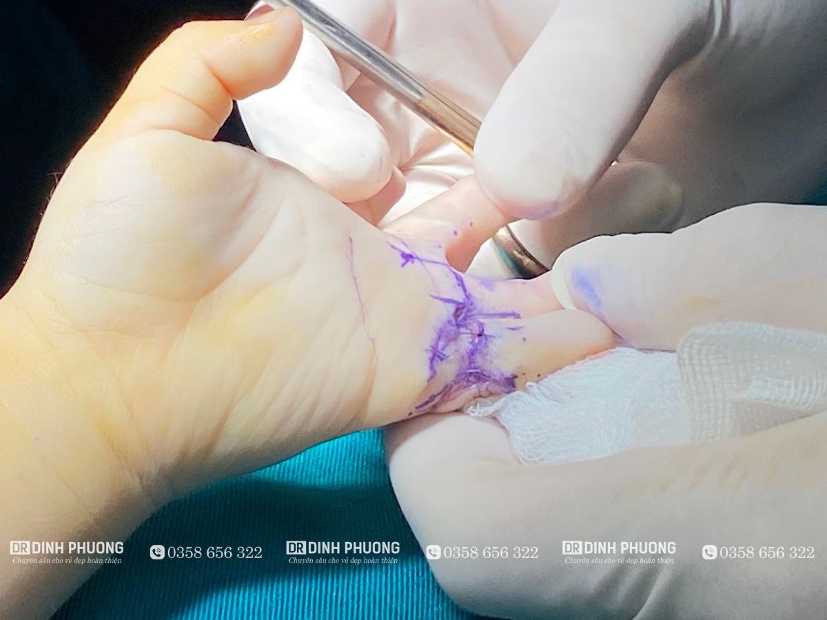 Kinh nghiệm giúp điều trị sẹo co kéo ngón tay hiệu quả