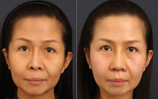 Mất tương quan giữa trụ mũi và cánh mũi