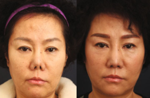 Mũi bị ngắn do sẹo co kéo