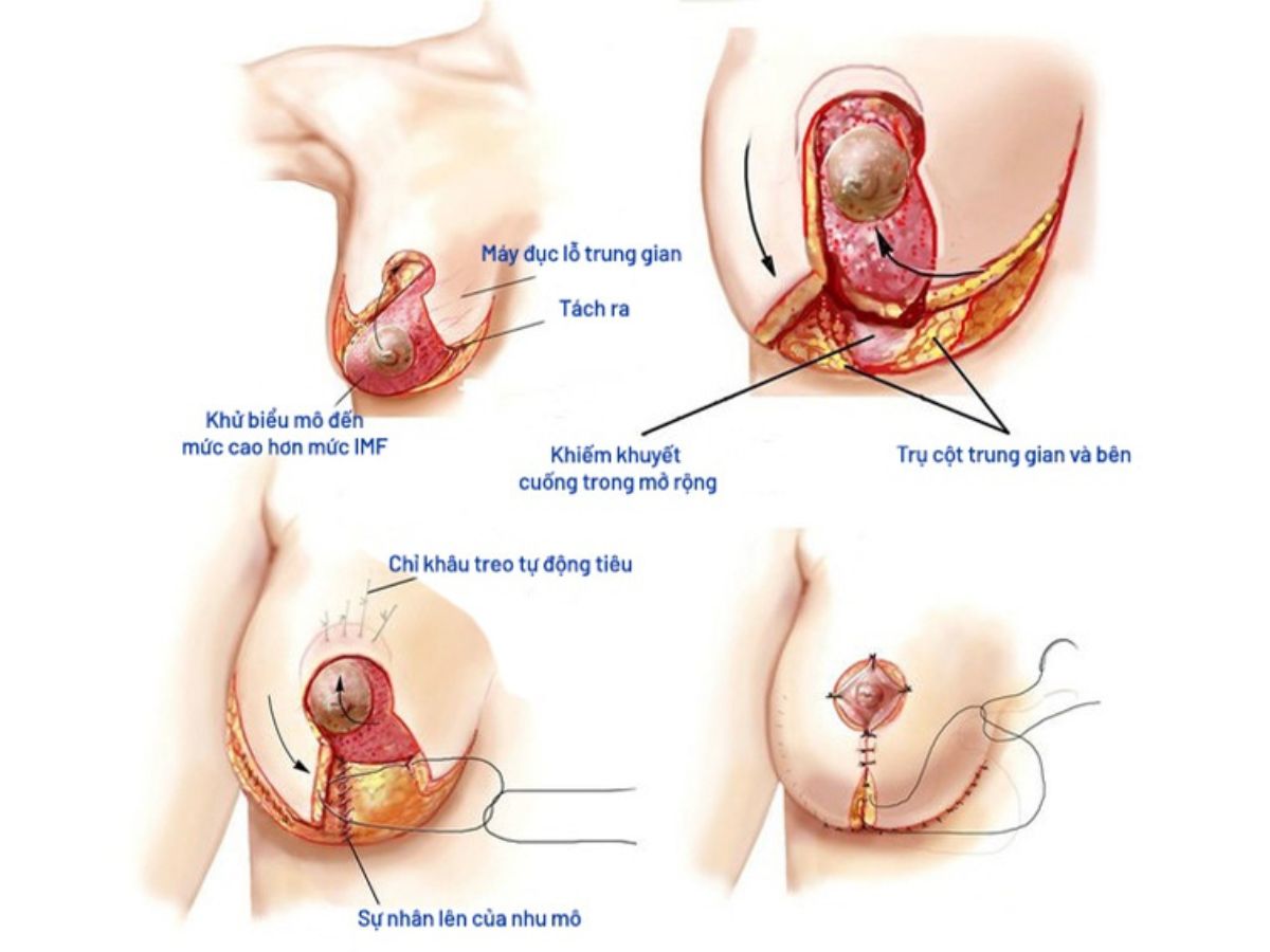 Phương pháp sử dụng mỡ tự thân giúp vòng 1 đầy đặn hơn
