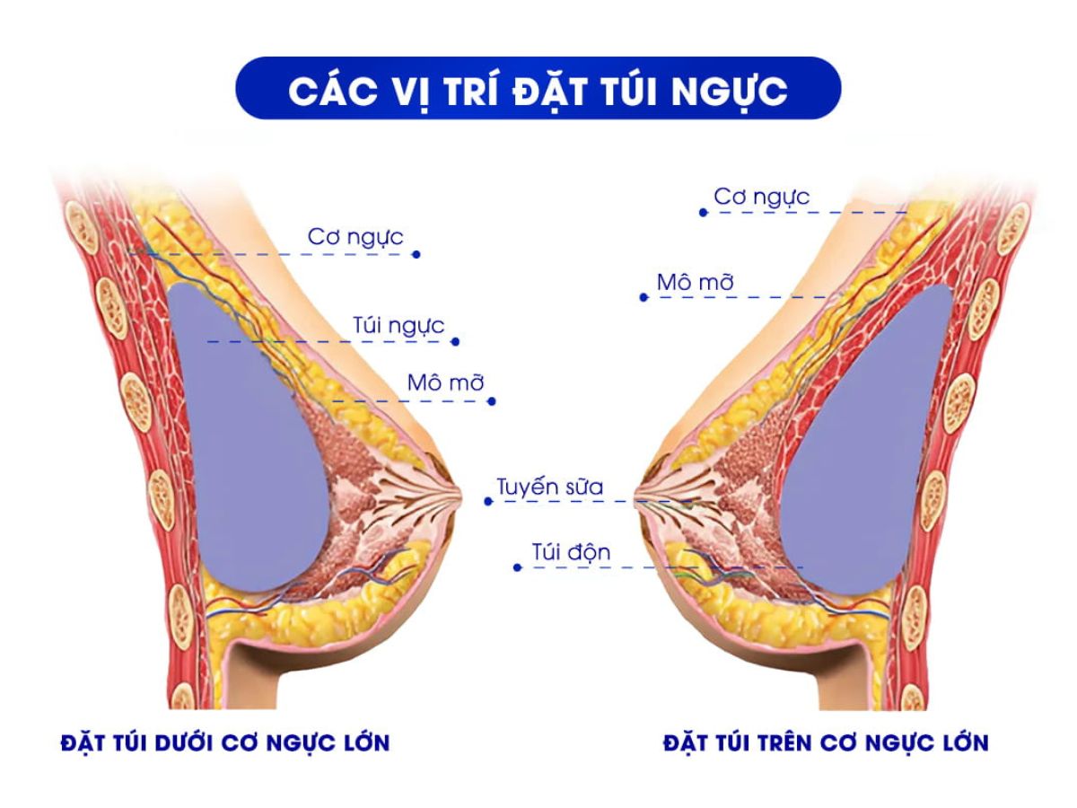 Phương pháp cải thiện hình dáng vòng 1 bằng túi độn ngực
