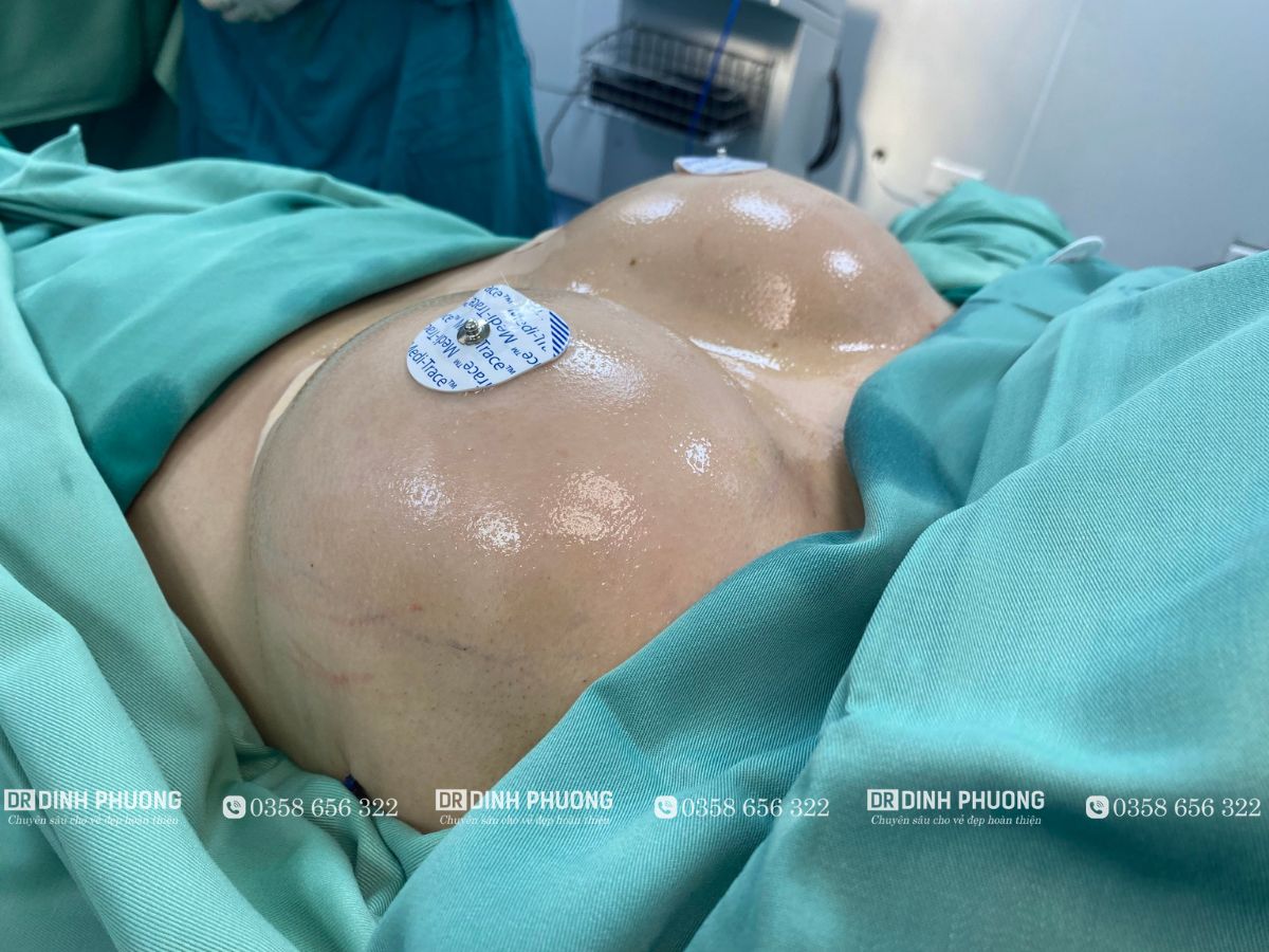 Nâng ngực chuẩn y khoa